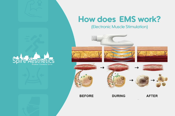 EMS treatment for post pregnancy weight loss treatment Hickstead