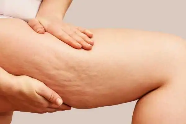 Image of woman showing leg with cellulite Hickstead