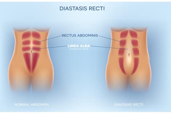 What Non-Surgical Options Are Available for Diastasis Recti Hickstead?