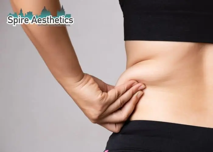 Image of woman pinching fat on their hips Hickstead. Fat Freezing treatment