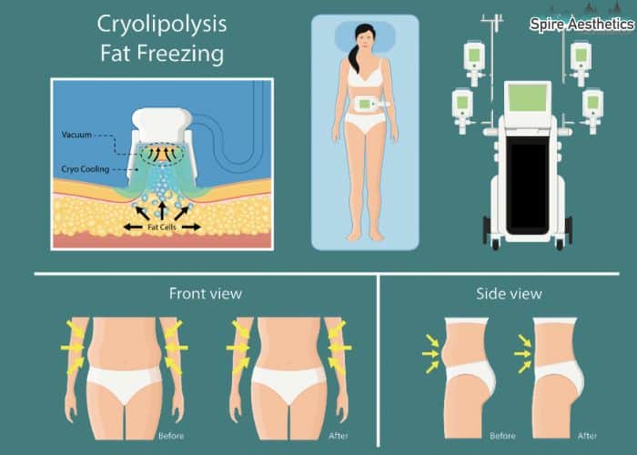 Image of diet and fat freezing combined for best results for Spire Aesthetics Hickstead