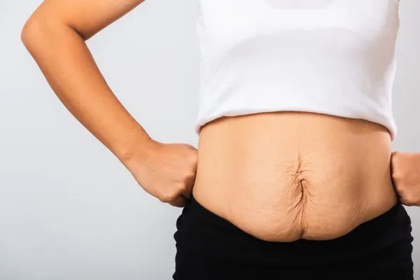 Image of a woman's stomach after weight loss with sagging skin following a gastric band Hickstead
