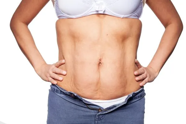 sagging skin on woman's stomach after weight loss injections Hickstead