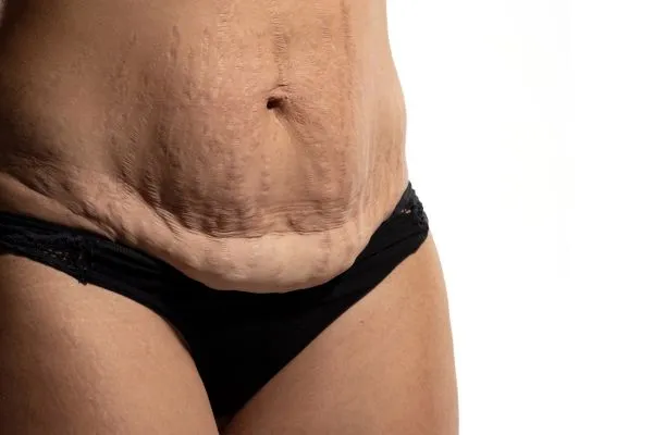 Image of womans stomach after weight loss injections Hickstead showing saggy skin