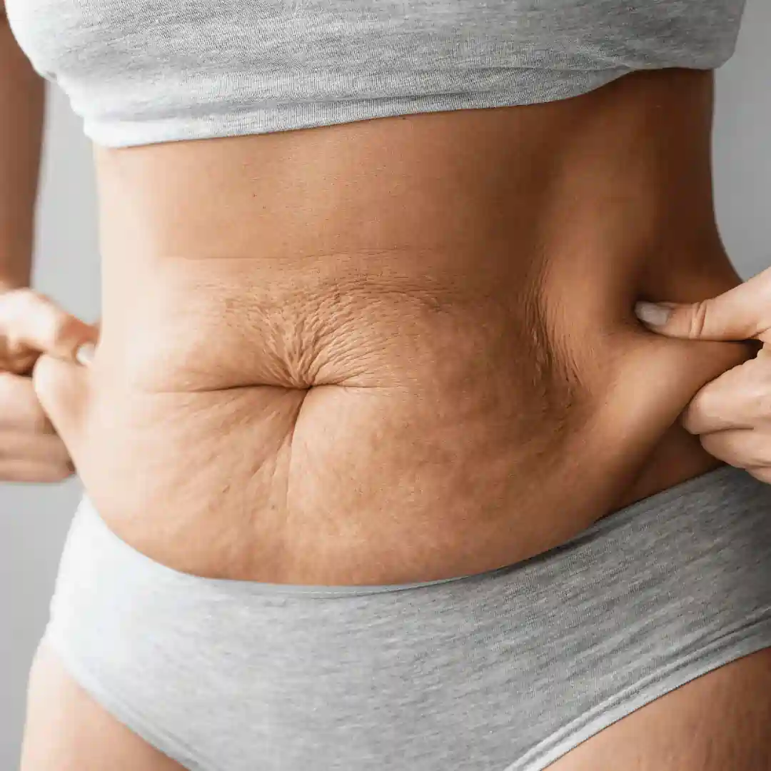 Is It Normal to Have Loose Skin After Pregnancy Hickstead?
