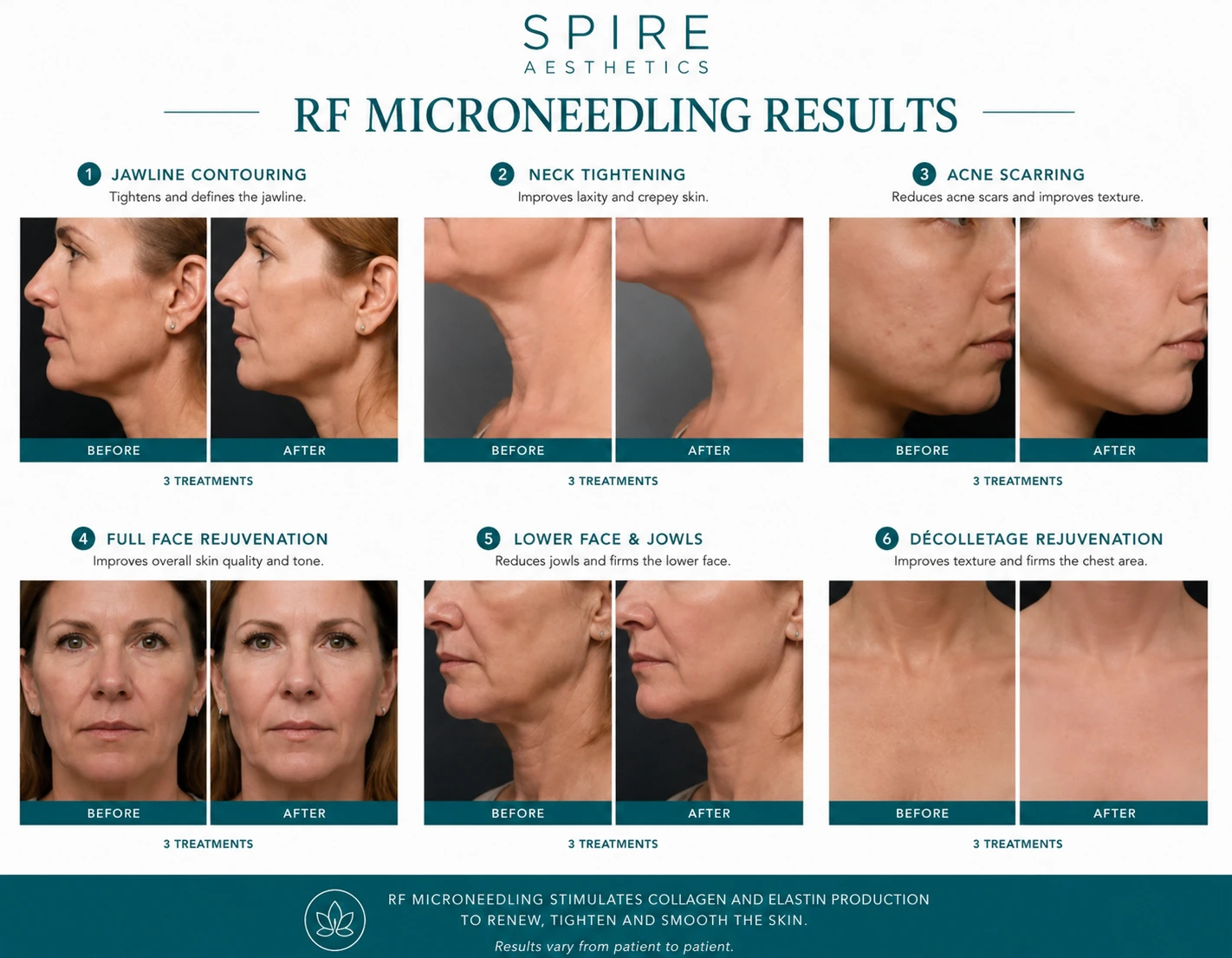 RF Microneedling Skin tightening Hickstead results