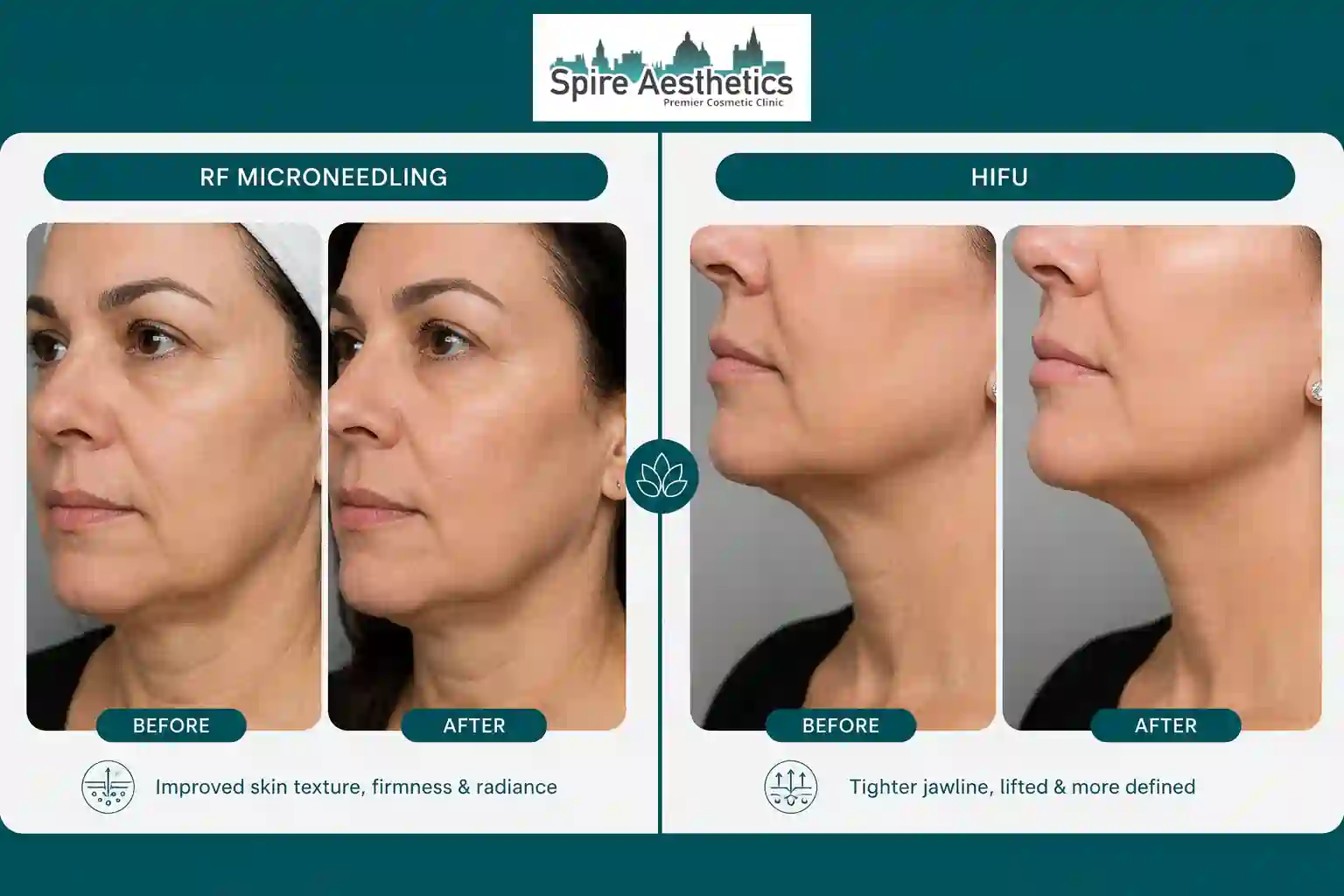 Can RF Microneedling and HIFU Be Combined Hickstead?