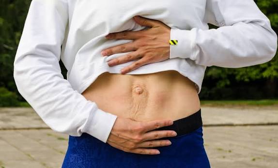 When Could Diastasis Recti Be the Missing Piece of the Puzzle Hickstead?