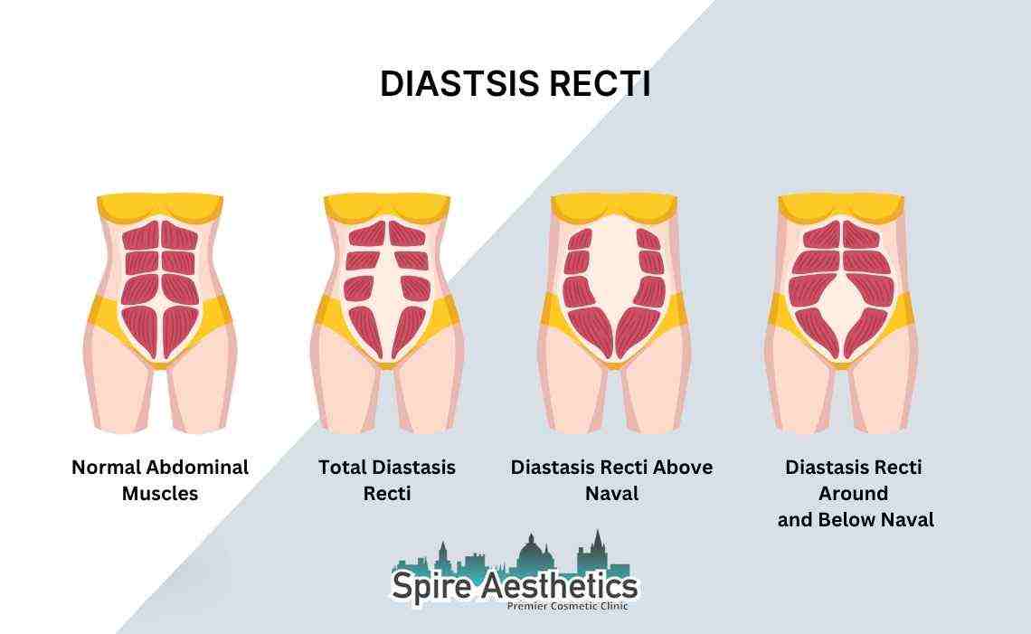 Is Non-Surgical Diastasis Recti Treatment Right for You? Common Concerns Answered Hickstead